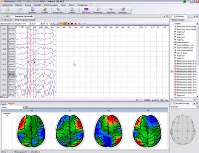 Evozierte Potentiale und Mapping