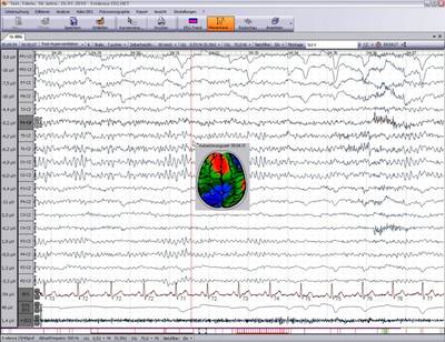 EEG - Aufzeichnung