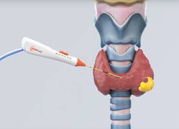 Radiofrequenzablation (RFA) in der Schilddrüsenchirurgie starmed schilddruese