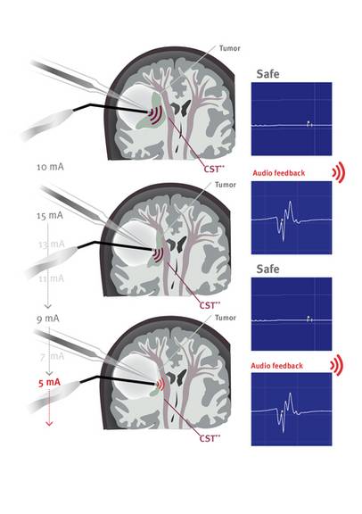 Mappingsauger Neurochirurgie