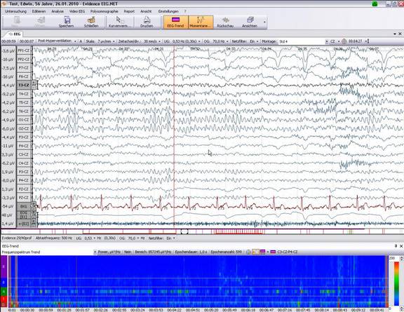 EEG mit Trend des Frequenzspektrums