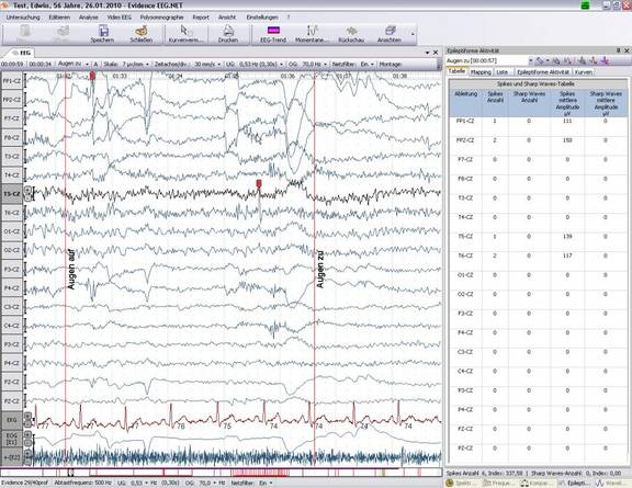 Spikes und Sharpe Waves-Tabelle